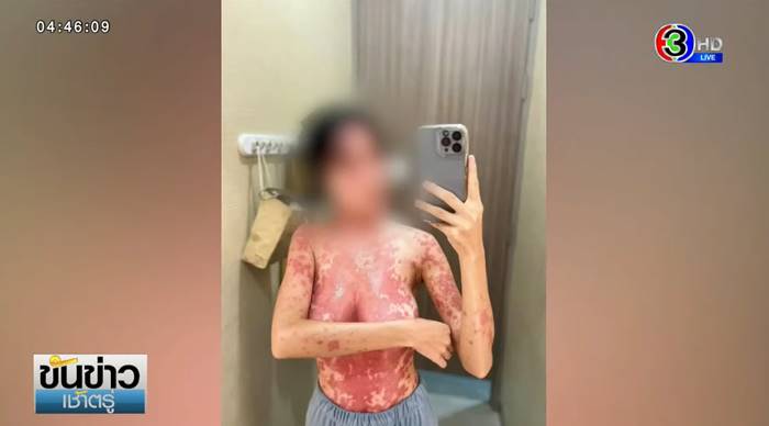 ภูมิแพ้ตัวเอง ภูมิแพ้ตัวเอง