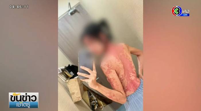 ภูมิแพ้ตัวเอง ภูมิแพ้ตัวเอง