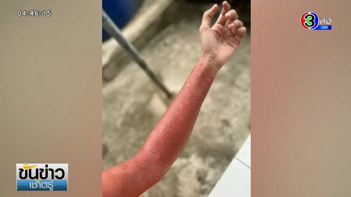 ภูมิแพ้ตัวเอง ภูมิแพ้ตัวเอง