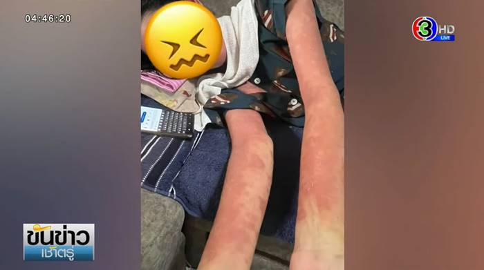 ภูมิแพ้ตัวเอง ภูมิแพ้ตัวเอง