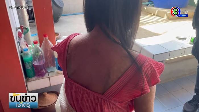 ภูมิแพ้ตัวเอง ภูมิแพ้ตัวเอง