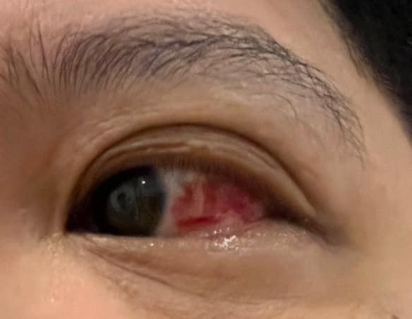 ลูกบ้านคอนโด ตาติดเชื้อ น้ำปนเปื้อน ลูกบ้านคอนโด ตาติดเชื้อ น้ำปนเปื้อน