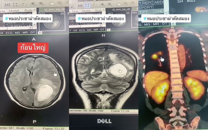หญิงปวดหัว บุหรี่ไม่สูบ เจอมะเร็งปอดลามขึ้นสมอง หญิงปวดหัว บุหรี่ไม่สูบ เจอมะเร็งปอดลามขึ้นสมอง