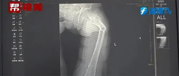 น้ำอัดลม ทำกระดูกต้นขาหัก น้ำอัดลม ทำกระดูกต้นขาหัก