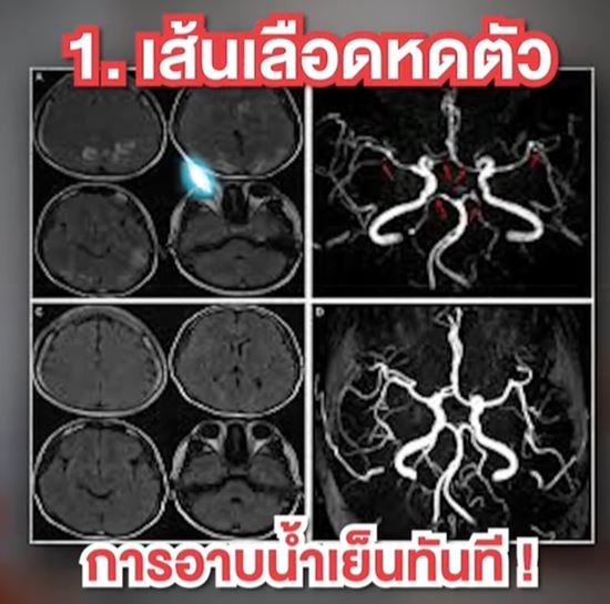 อาบน้ำในหน้าหนาว เสี่ยง เส้นเลือดในสมองแตก อาบน้ำในหน้าหนาว เสี่ยง เส้นเลือดในสมองแตก