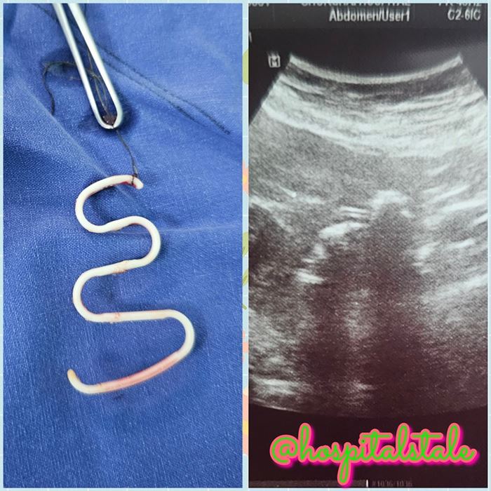 ห่วงคุมกำเนิด ห่วงคุมกำเนิด