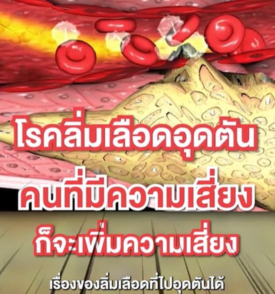 อาบน้ำในหน้าหนาว เสี่ยง เส้นเลือดในสมองแตก อาบน้ำในหน้าหนาว เสี่ยง เส้นเลือดในสมองแตก