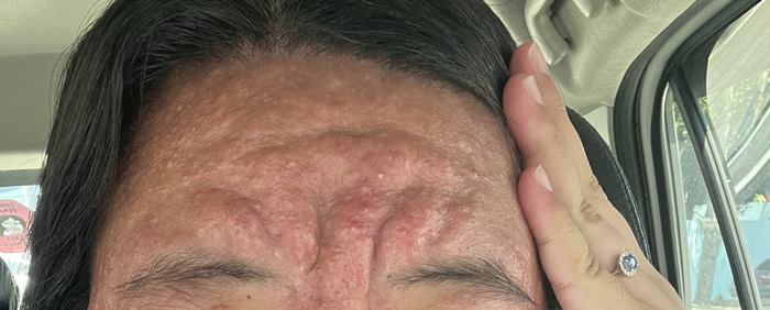 สาวแชร์ประสบการตั้งครรภ์ สิวผุดจนหน้าบวมเป่ง สาวแชร์ประสบการตั้งครรภ์ สิวผุดจนหน้าบวมเป่ง