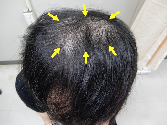 หัวล้าน เพราะ โรคซิฟิลิส หัวล้าน เพราะ โรคซิฟิลิส