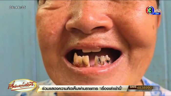 รอคิวทำฟันบัตรทอง 8 ปี รอคิวทำฟันบัตรทอง 8 ปี