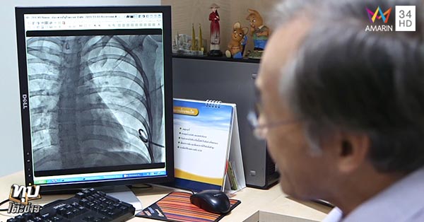 ฝังเข็ม ฝังเข็ม