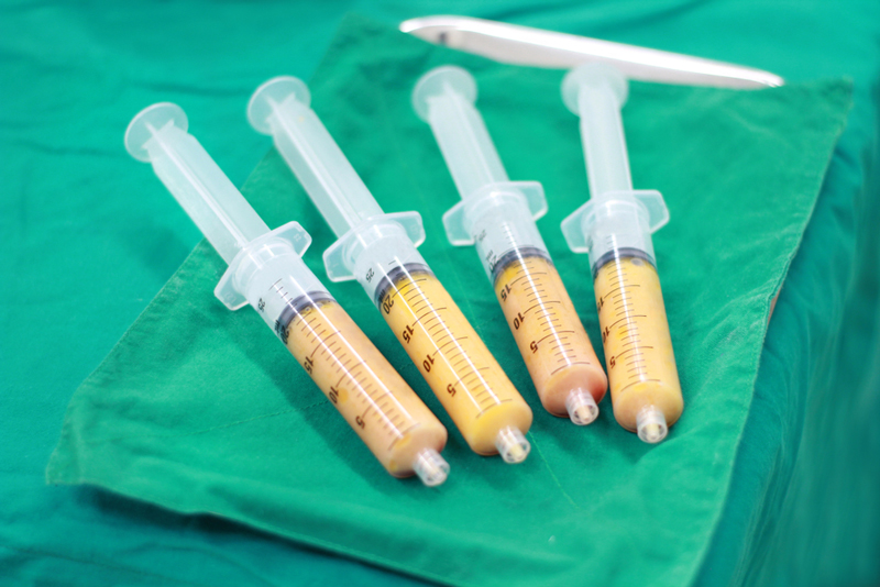 ดูดไขมันตาย ดูดไขมันตาย