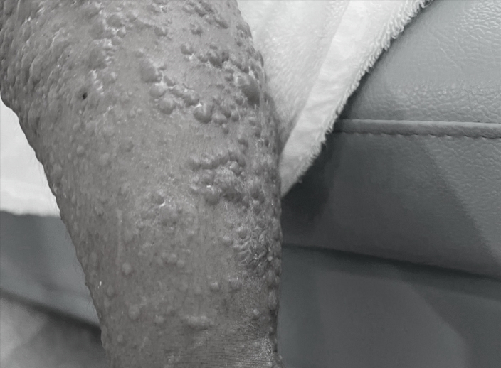 โรคไข้หวัดมะเขือเทศ โรคไข้หวัดมะเขือเทศ