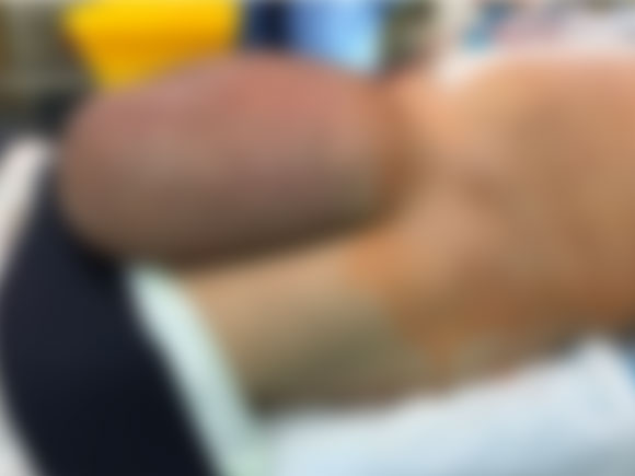 ไส้เลื่อน ไส้เลื่อน