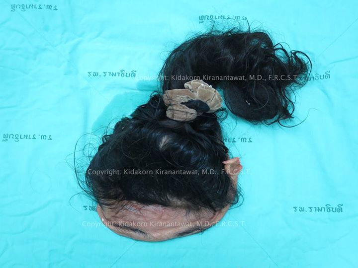 สยอง ! สาวโรงงานพลาดถูกเครื่องจักรกระชากหนังหัวหลุด สยอง ! สาวโรงงานพลาดถูกเครื่องจักรกระชากหนังหัวหลุด