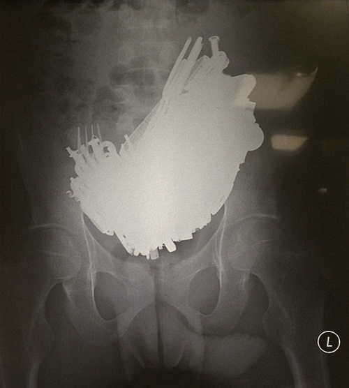 ไม่เชื่อก็ต้องเชื่อ สิ่งที่คุณเห็นเหล่านี้ถูกผ่าออกมาจากท้องมนุษย์ ไม่เชื่อก็ต้องเชื่อ สิ่งที่คุณเห็นเหล่านี้ถูกผ่าออกมาจากท้องมนุษย์