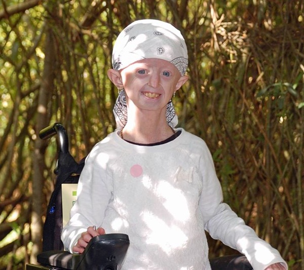 เด็กสาวชาวอังกฤษป่วยโรคแก่ก่อนวัย เสียชีวิตแล้วในวัย 17 ปี เด็กสาวชาวอังกฤษป่วยโรคแก่ก่อนวัย เสียชีวิตแล้วในวัย 17 ปี