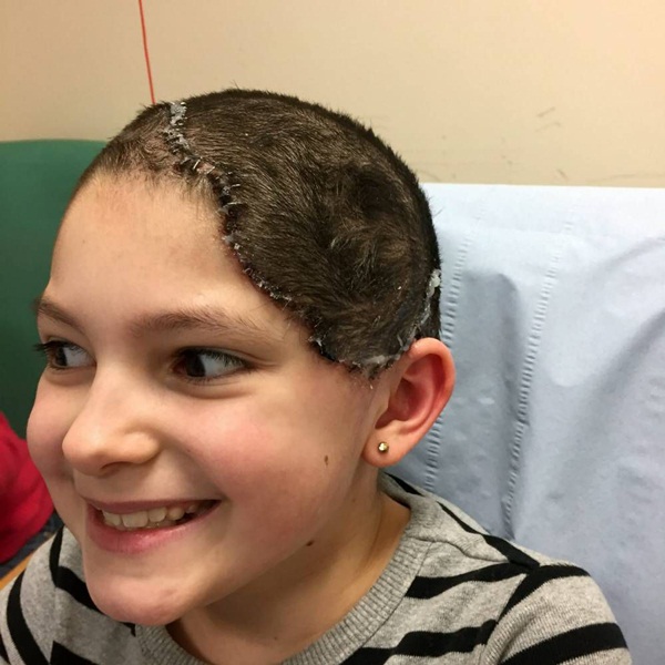 แพทย์ผ่าตัดฝังบอลลูนบนหัวเด็กหญิง แพทย์ผ่าตัดฝังบอลลูนบนหัวเด็กหญิง