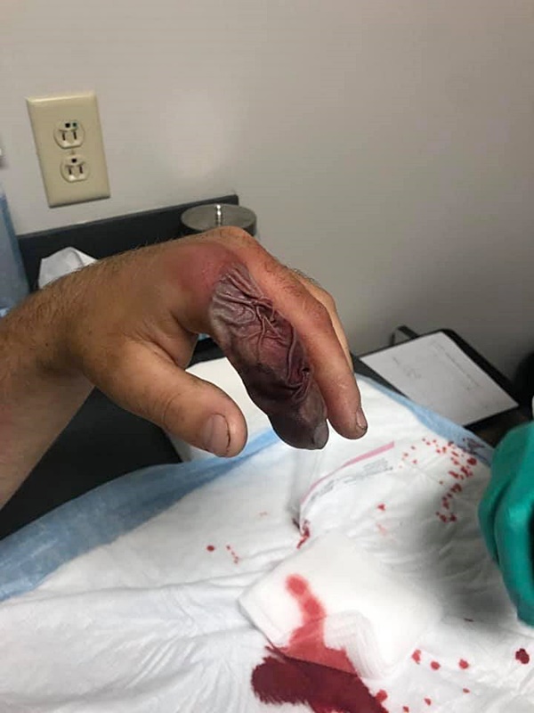 งูกัด งูกัด