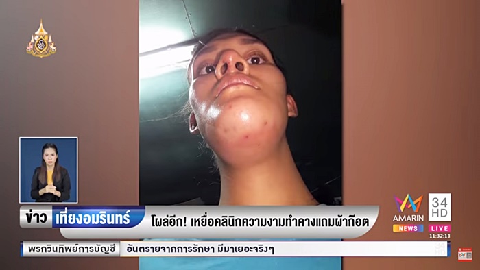 ศัลยกรรมหน้าพัง ศัลยกรรมหน้าพัง