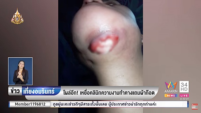 ศัลยกรรมหน้าพัง ศัลยกรรมหน้าพัง