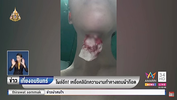 ศัลยกรรมหน้าพัง ศัลยกรรมหน้าพัง