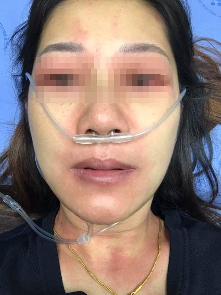 แพ้อาหาร แพ้อาหาร