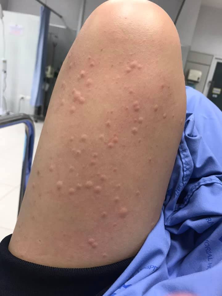 แพ้อาหาร แพ้อาหาร