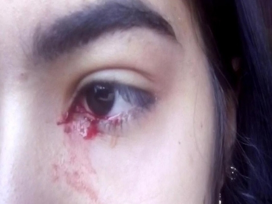 เด็กสาววัย 15 ร้องไห้น้ำตาไหลเป็นเลือด เด็กสาววัย 15 ร้องไห้น้ำตาไหลเป็นเลือด