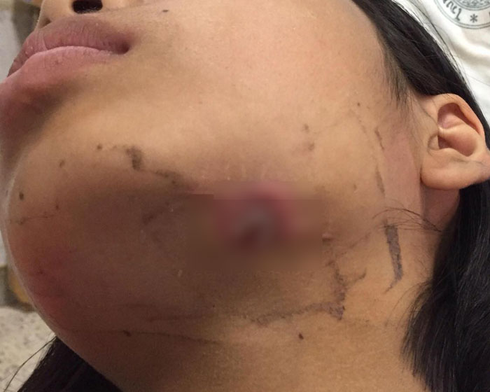 ฟันผุ. ฟันผุ.