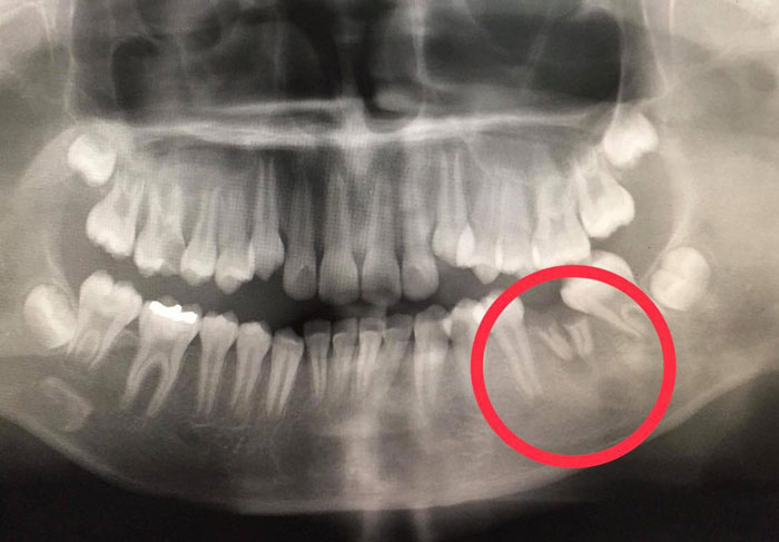 ฟันผุ. ฟันผุ.