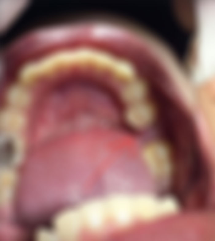 ฟันผุ. ฟันผุ.