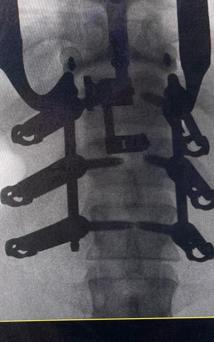 ไฟไหม้โซเนวา คีรี ไฟไหม้โซเนวา คีรี