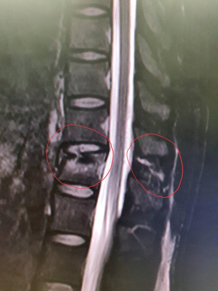 ไฟไหม้โซเนวา คีรี ไฟไหม้โซเนวา คีรี