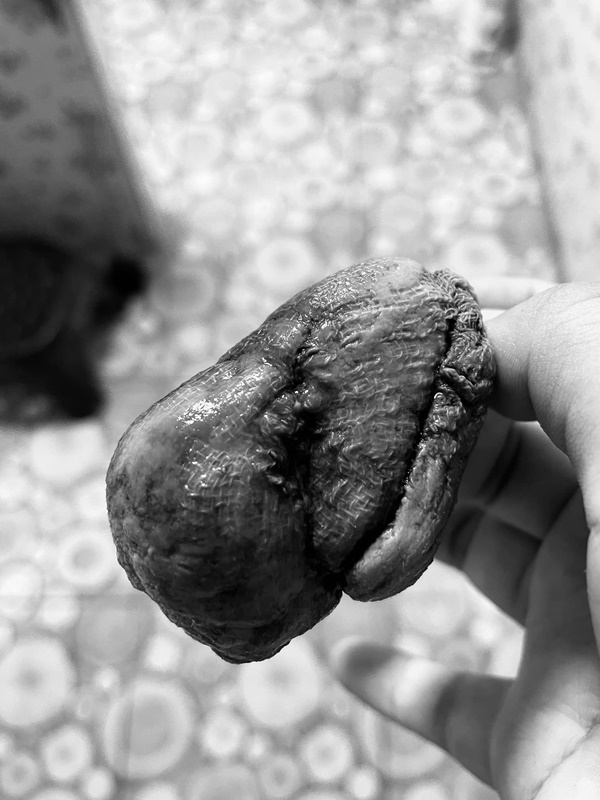 ลืมผ้าก๊อซในช่องคลอด ลืมผ้าก๊อซในช่องคลอด