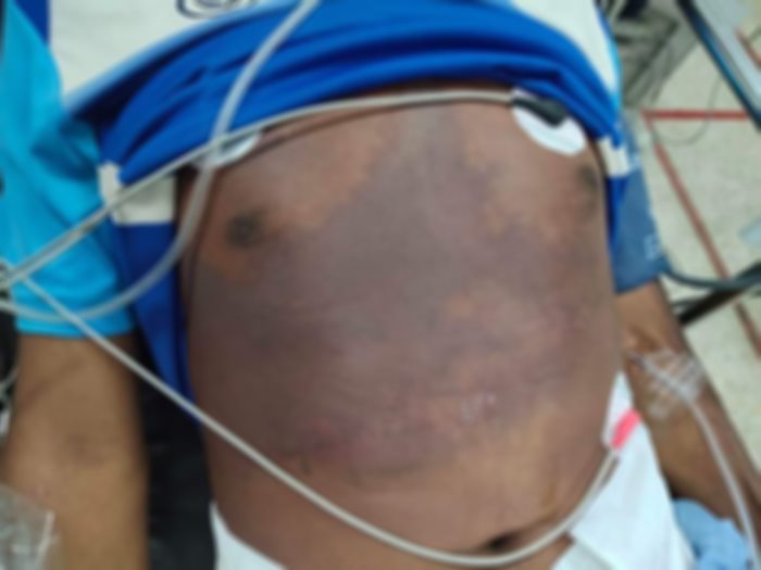 แบคทีเรียกินเนื้อ แบคทีเรียกินเนื้อ