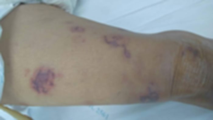 แบคทีเรียกินเนื้อ แบคทีเรียกินเนื้อ