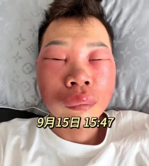 แคะจมูกจนหน้าบวม แคะจมูกจนหน้าบวม