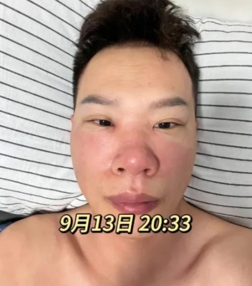 แคะจมูกจนหน้าบวม แคะจมูกจนหน้าบวม