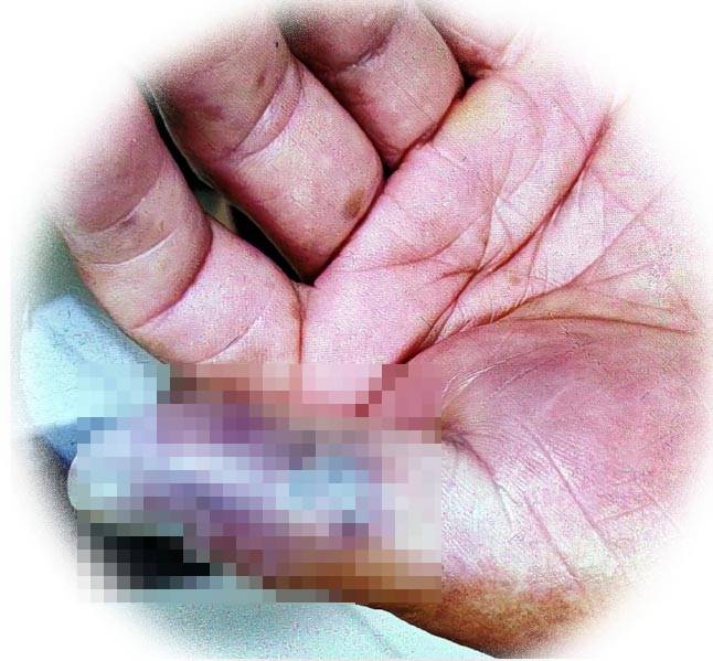 ชายโดนกุ้งทิ่มมือ ชายโดนกุ้งทิ่มมือ