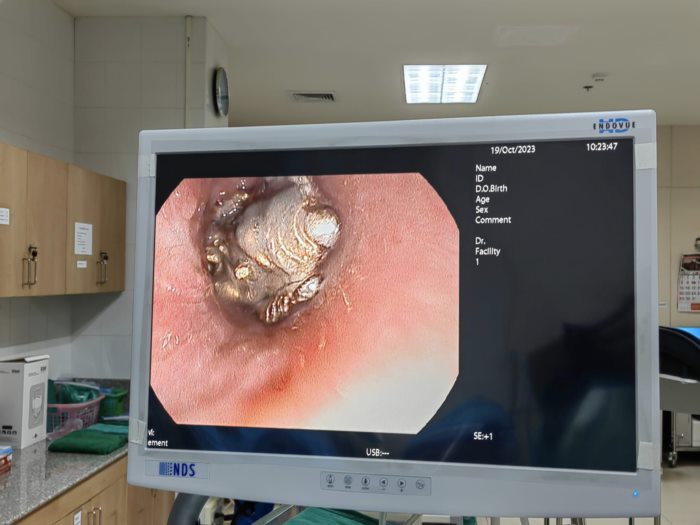 พระพิฆเนศ สำลักเข้าหลอดลม พระพิฆเนศ สำลักเข้าหลอดลม