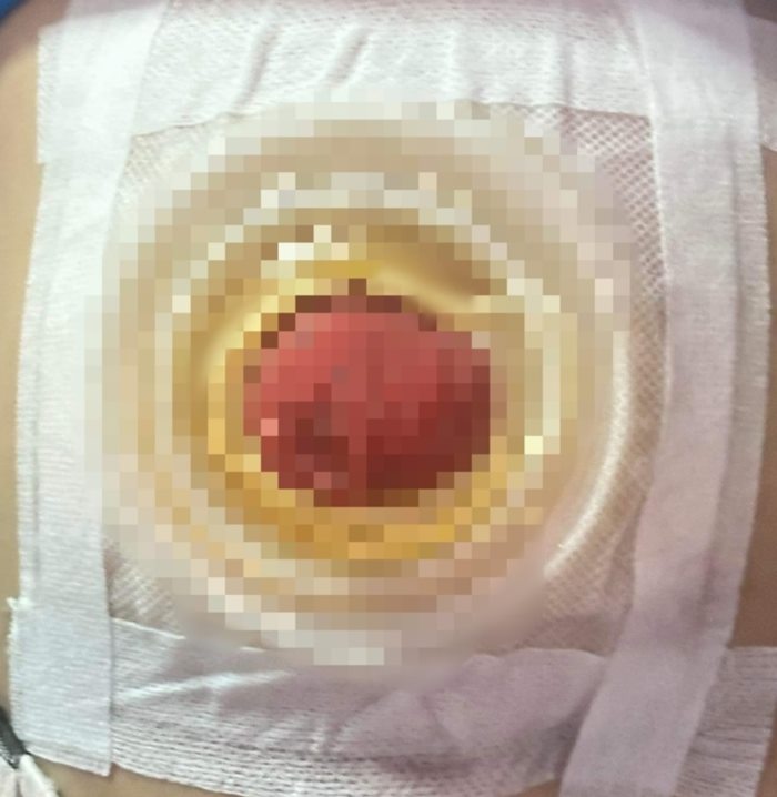 ผ่าคลอด ผ่าคลอด