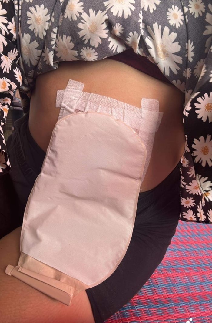 ผ่าคลอด ผ่าคลอด