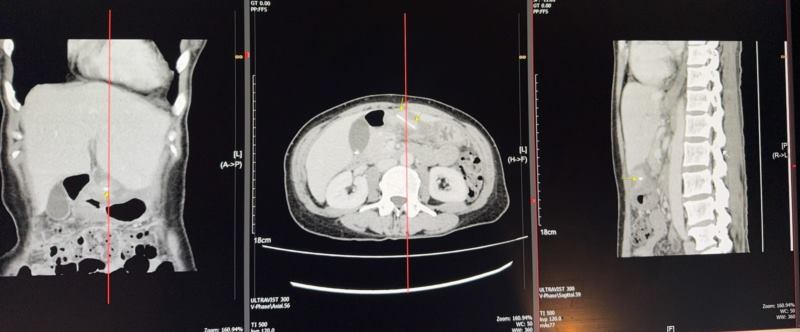 ก้างปลาทะลุกระเพาะ ก้างปลาทะลุกระเพาะ