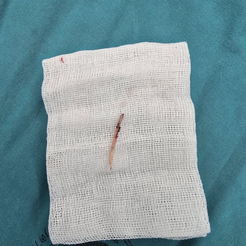 ก้างปลาทะลุกระเพาะ ก้างปลาทะลุกระเพาะ