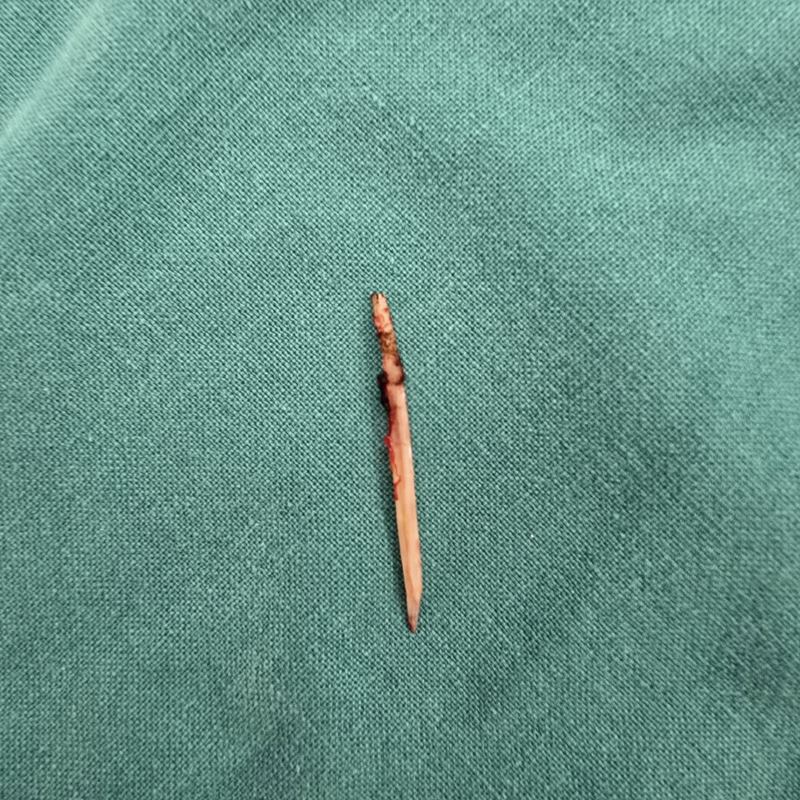 ก้างปลาทะลุกระเพาะ ก้างปลาทะลุกระเพาะ