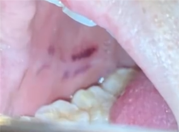 ประทัดระเบิดคาปาก ประทัดระเบิดคาปาก