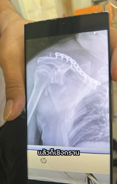 พิมรี่พาย ใจจะขาด พ่อประสบอุบัติเหตุ - บิ๊กไบค์ขาด 2 ท่อน พิมรี่พาย ใจจะขาด พ่อประสบอุบัติเหตุ - บิ๊กไบค์ขาด 2 ท่อน