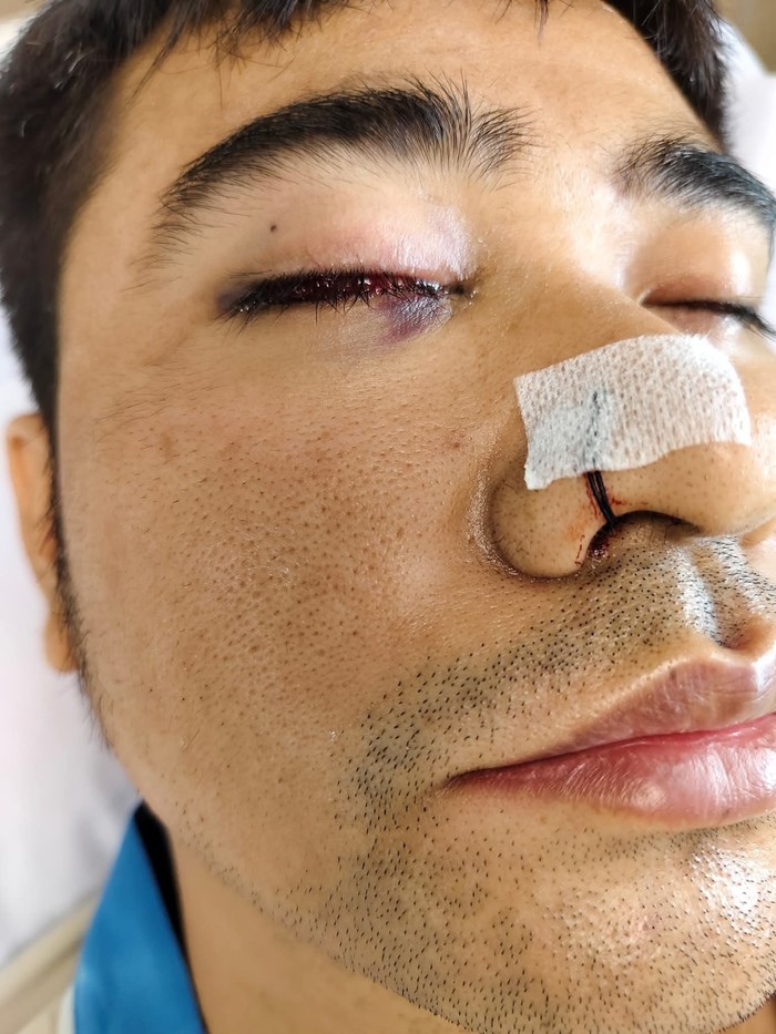 ริดสีดวงจมูก ผ่าตัดรักษา ทำให้ตามองไม่เห็น ริดสีดวงจมูก ผ่าตัดรักษา ทำให้ตามองไม่เห็น