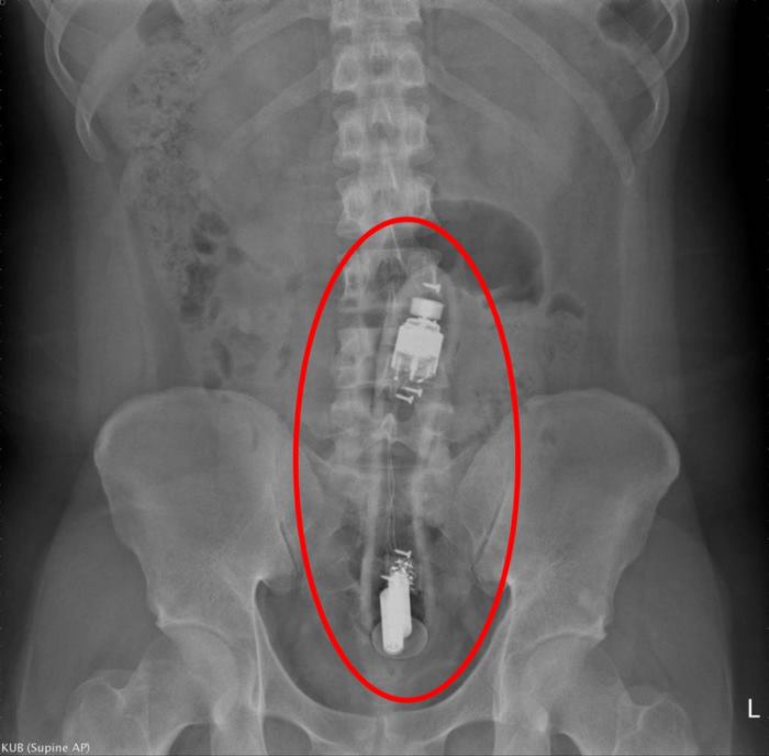 ลำไส้ทะลุ ลำไส้ทะลุ